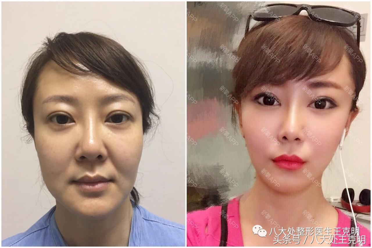 杨紫的法令纹能消除吗,杨紫法令纹很深怎么回事