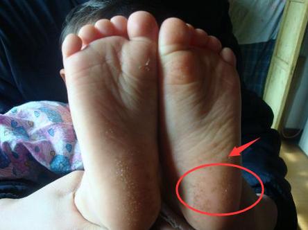 肝癌脸色发黑身体消瘦黄疸怎么办,小孩身体发黑要警惕四种病