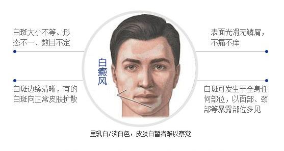 白癜风的四个初期症状,白癜风常见的20个问题