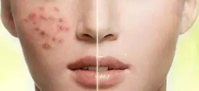 不要把毛囊炎当成青春痘,医生把毛囊炎当成痤疮