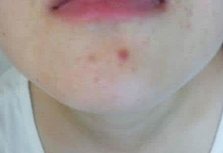 脸上长痘?不同部位有不同的破解法,看看你是哪种?