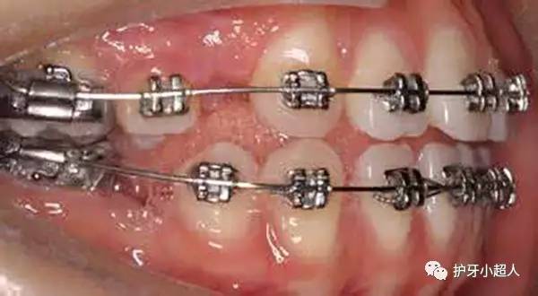 牙套材质钴镍哪个好,安牙套什么材质好