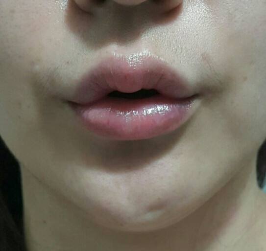 很多人嘴唇上有一道疤,为什么上嘴唇会多出一点肉