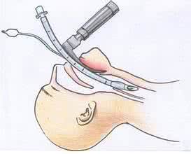 肺部手术后咳嗽胸前鼓包正常吗,肺部手术后怎么避免肺不张