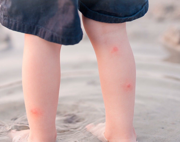 宝宝被蚊虫叮咬后如何正确处理,婴儿夏季蚊虫叮咬用什么药