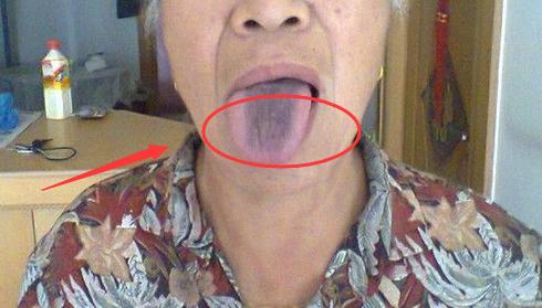 肝癌脸色发黑身体消瘦黄疸怎么办,小孩身体发黑要警惕四种病