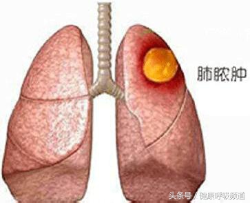 你咳什么样的痰，我就知道你得的是什么病！