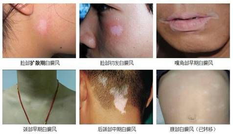 身上长白斑是白癜风吗如何确诊,身上出现白斑都是白癜风吗