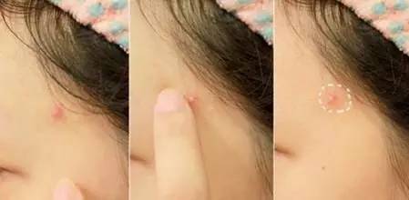 额头长痘痘需要注意什么,额头长痘痘是哪里出问题怎么解决