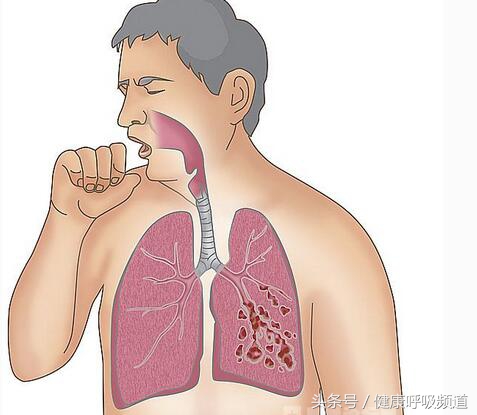 你咳什么样的痰，我就知道你得的是什么病！