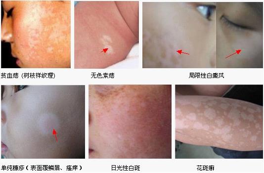 白癜风的四个初期症状,白癜风常见的20个问题