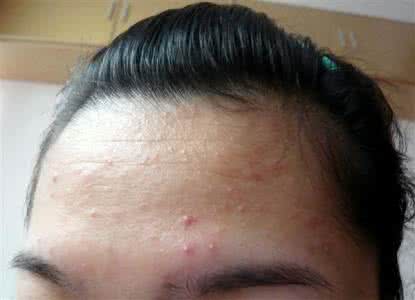 脸上长痘?不同部位有不同的破解法,看看你是哪种?