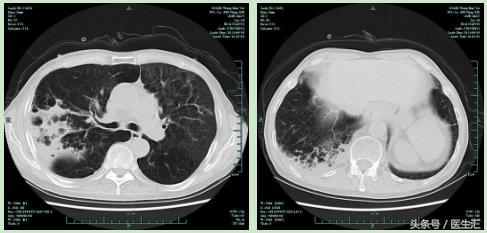 社区获得性肺炎非重症dr报告单,copd慢性阻塞性肺炎案例分析