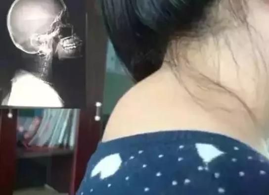 艾灸可以消除富贵包吗最有效,艾灸富贵包后很痒是什么原因