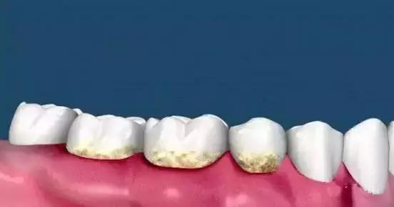 牙齿矫正最怕遇到牙套,牙齿矫正的时候老是害怕牙齿脱落