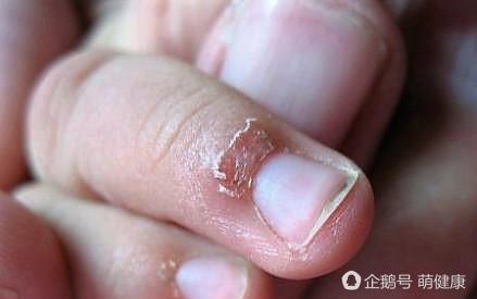 女生手有倒刺化脓,十岁女孩手上长满倒刺