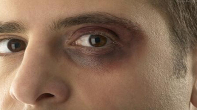 眼圈发黄警惕四种病,眼圈经常发黑是什么病的预兆