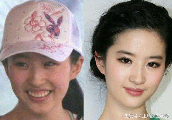 露龈笑矫正危害大吗,露龈笑毁了一辈子