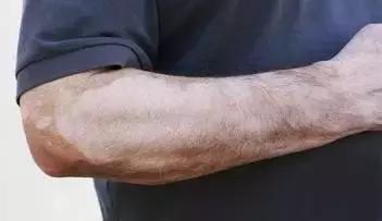 白癜风治疗要小心走入误区,白癜风自我诊断小妙招