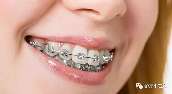 牙套材质钴镍哪个好,安牙套什么材质好