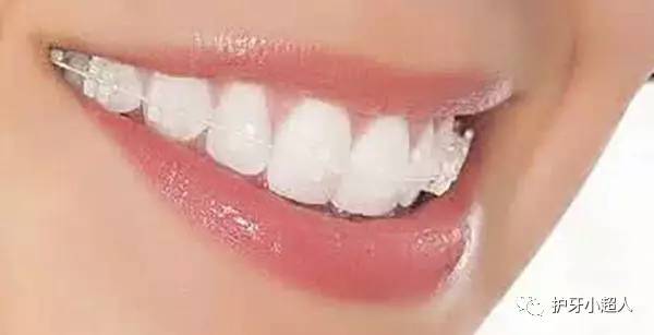 牙套材质钴镍哪个好,安牙套什么材质好