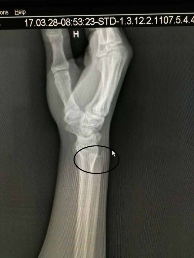 腕部损伤恢复方法,腕部受伤一般多久恢复