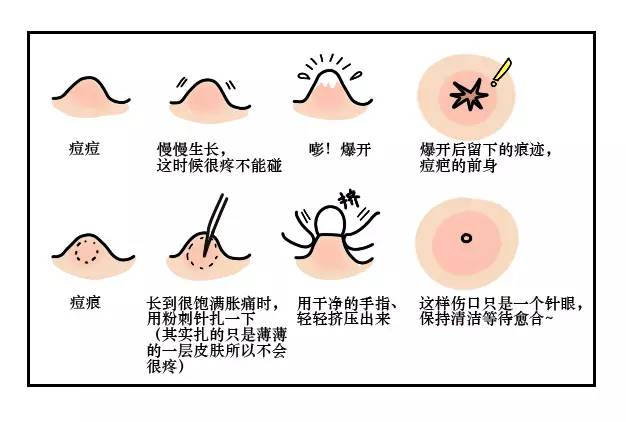 这可能是夏天穿吊带最大的烦恼……这可能是背部痘痘最全攻略