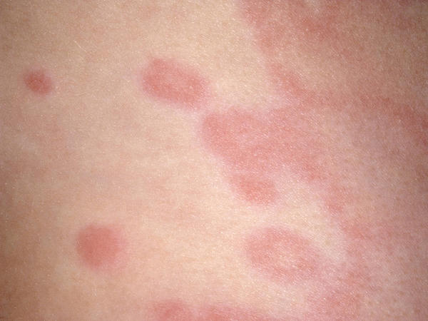 宝宝皮肤常见“痘痘”,看图学习,快点收藏起来!