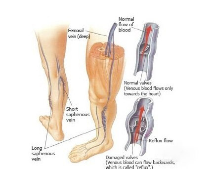 精索静脉曲张影响怀孕吗,孕期静脉曲张会影响胎儿吗
