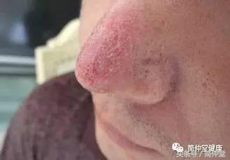 鼻翼两侧发红溃烂,鼻翼两侧发红是螨虫吗