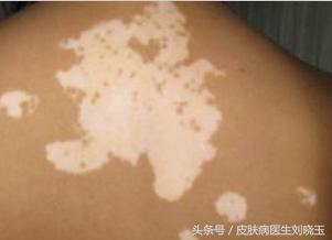 判断白癜风是不是白癜风最佳方法,重视白癜风要了解白癜风的危害