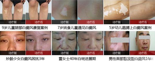 判断白癜风是不是白癜风最佳方法,重视白癜风要了解白癜风的危害