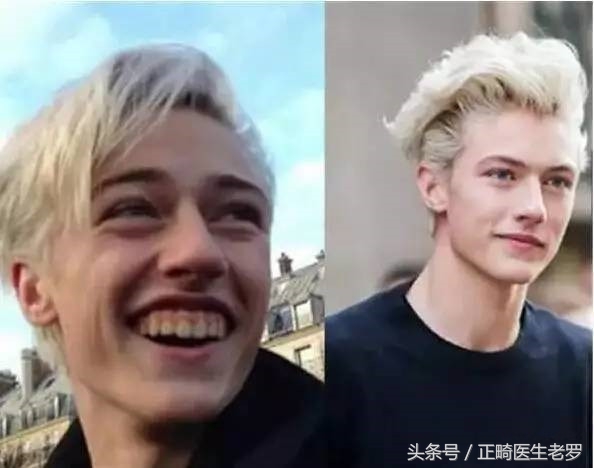 露龈笑矫正危害大吗,露龈笑毁了一辈子
