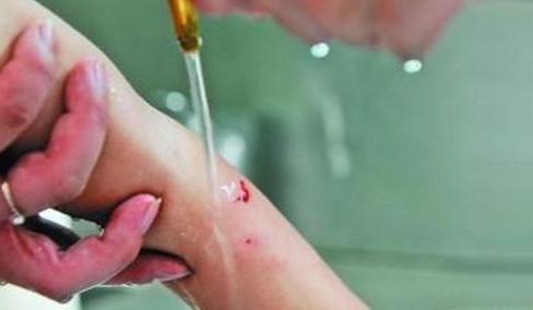 被狗狗咬了该怎么处理,被狗狗咬了要注意哪些事项