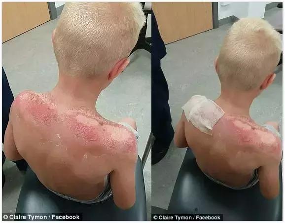 宝宝涂了防晒霜可以防晒几个小时,儿童晒伤防晒霜