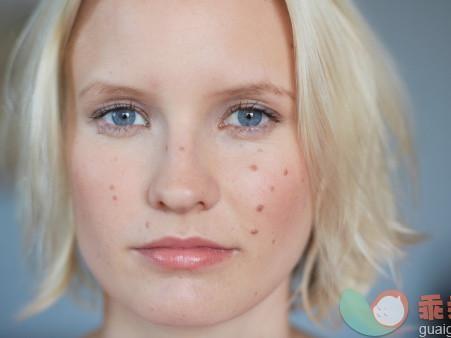 治疗激素脸大概需要多少钱,过敏激素脸正确治疗方法