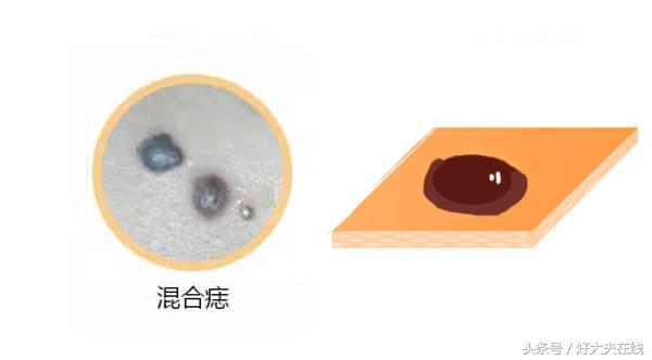痣短期变大一定是恶化吗,医生能否判断痣是否正常