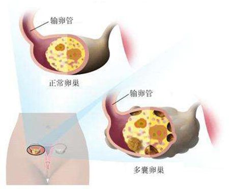 多囊卵巢综合症可以喝豆浆吗,多囊卵巢综合症可以做试管吗