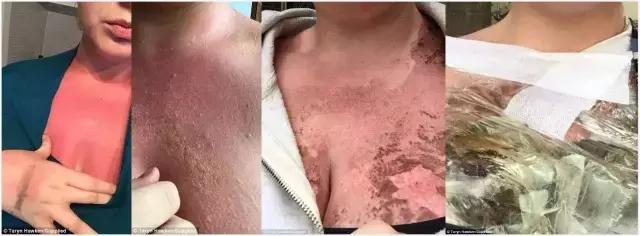 宝宝涂了防晒霜可以防晒几个小时,儿童晒伤防晒霜