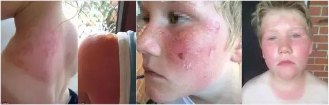 宝宝涂了防晒霜可以防晒几个小时,儿童晒伤防晒霜