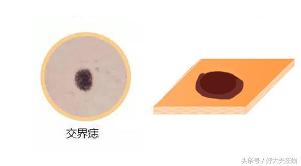 痣短期变大一定是恶化吗,医生能否判断痣是否正常
