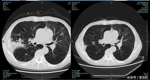 社区获得性肺炎非重症dr报告单,copd慢性阻塞性肺炎案例分析