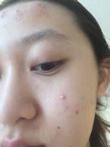 脸上长痘?不同部位有不同的破解法,看看你是哪种?