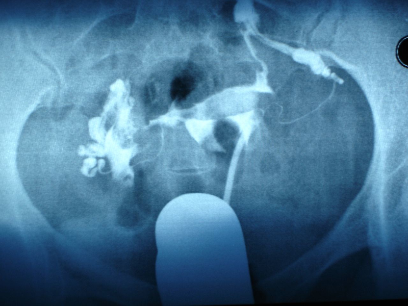 胎盘生不出来怎么办,胎盘出不来为什么不能剖腹