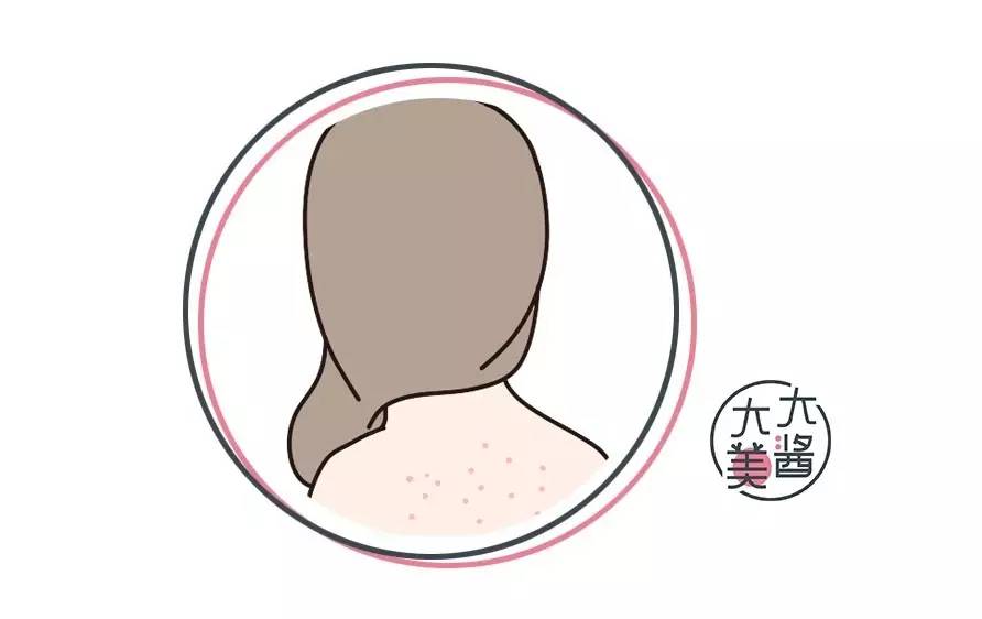 这可能是夏天穿吊带最大的烦恼……这可能是背部痘痘最全攻略