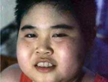 2岁开始肾病综合征能根治吗,肾病综合征膜性肾病能根治好吗