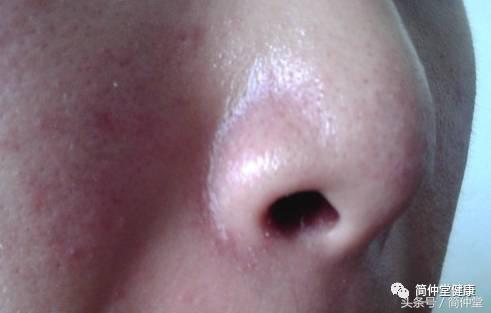 鼻翼两侧发红溃烂,鼻翼两侧发红是螨虫吗