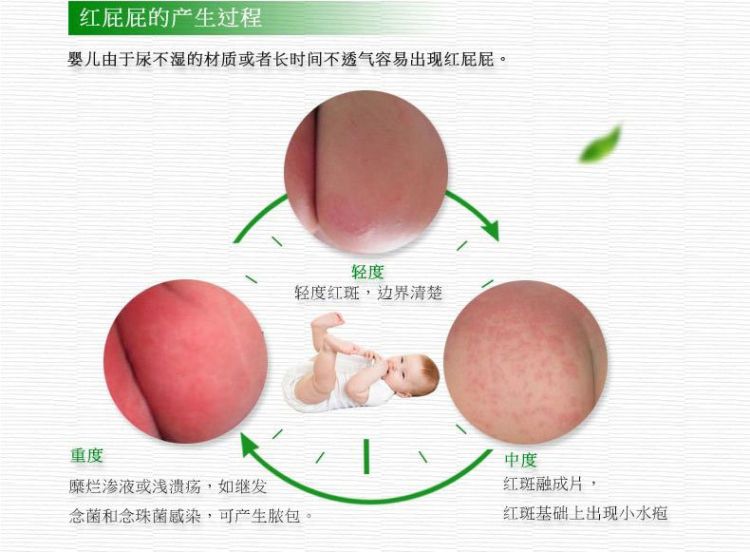 新手怎么护理宝宝红屁股,宝宝红屁股妈妈饮食注意