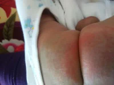 新手怎么护理宝宝红屁股,宝宝红屁股妈妈饮食注意