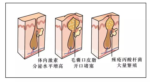 这可能是夏天穿吊带最大的烦恼……这可能是背部痘痘最全攻略